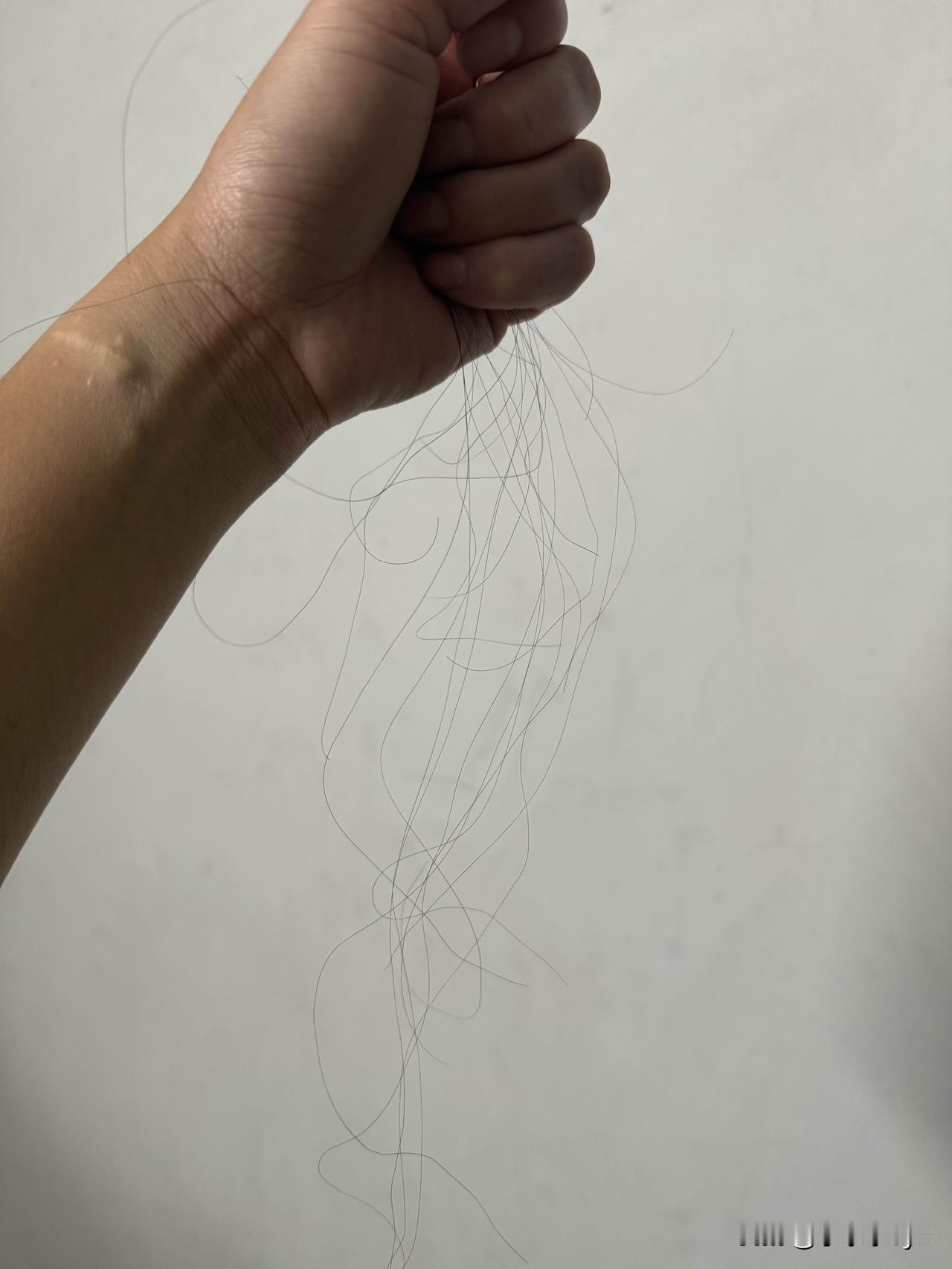 按这样的掉发速度，迟早变秃头小宝贝…

肾移植以后有一段时间掉发挺严重的，有一段