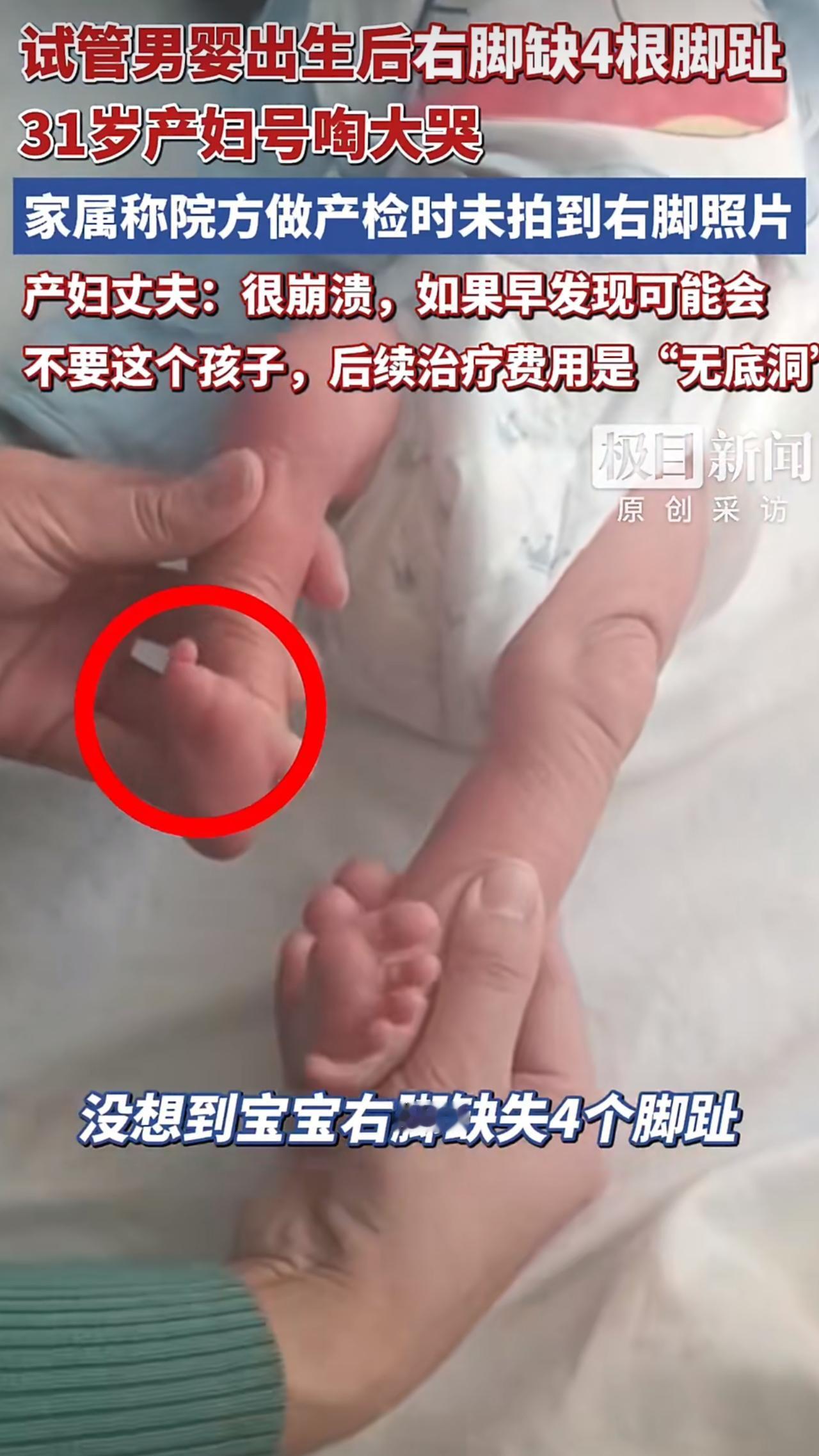 山东一对夫妇历经试管婴儿成功受孕，却在孩子诞生后遭遇晴天霹雳，新生儿右脚仅存小脚