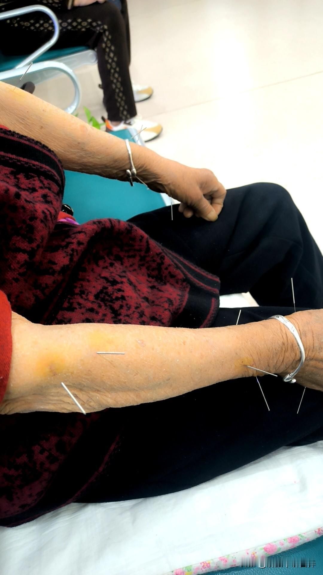 针灸，扎穴位，不知道是否有效。