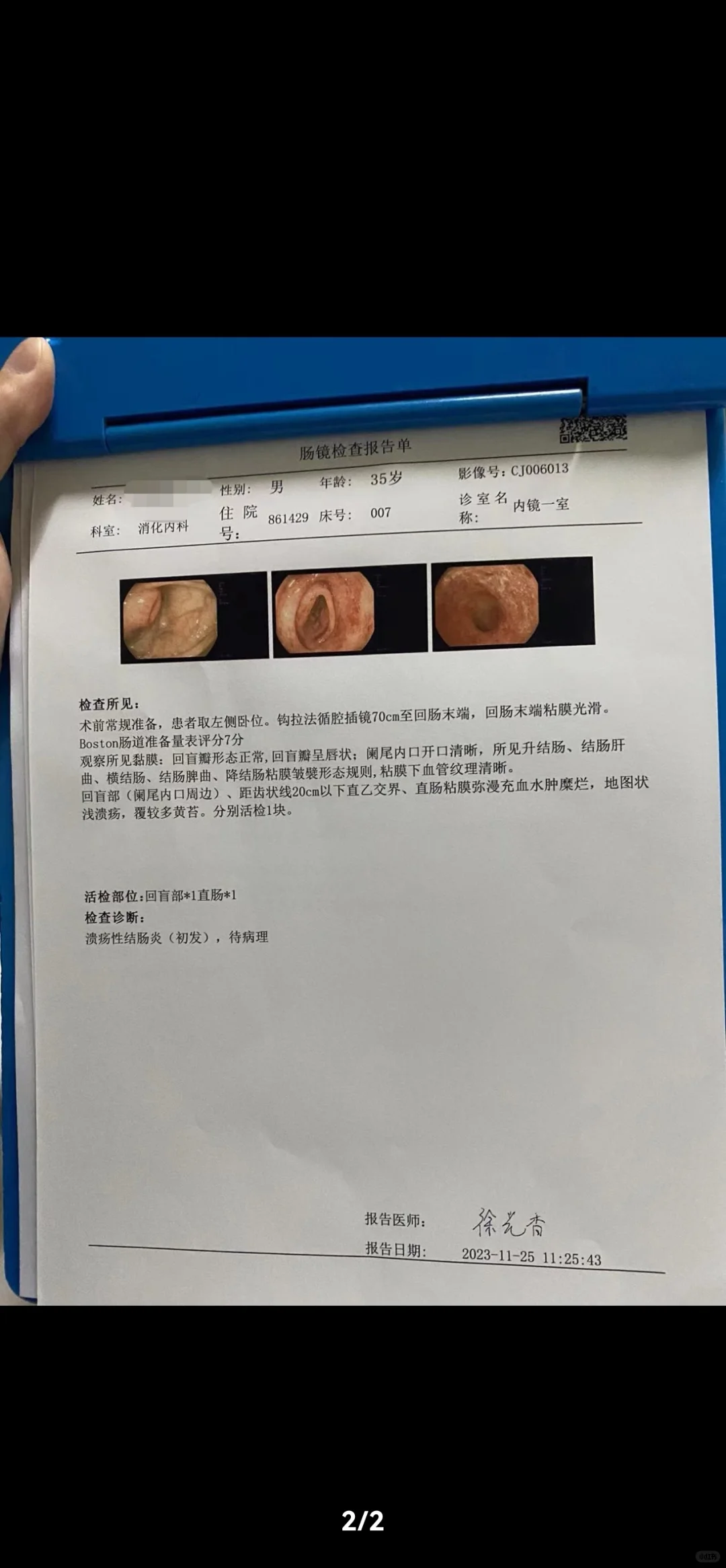 溃疡性结肠炎内镜评估需要严格。