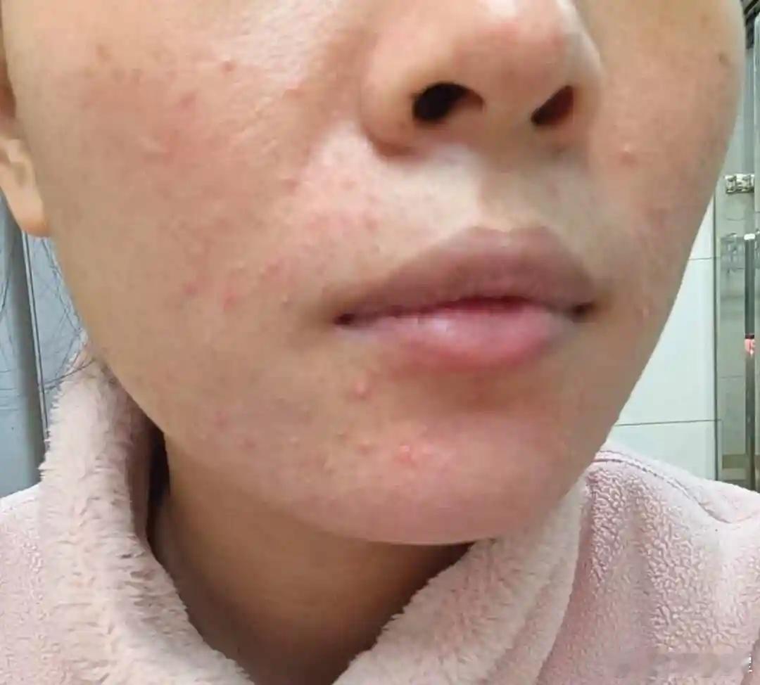 中药外敷治疗痤疮是中医皮肤科的常用方法，通过将中药制成膏剂、散剂、面膜等形式直接