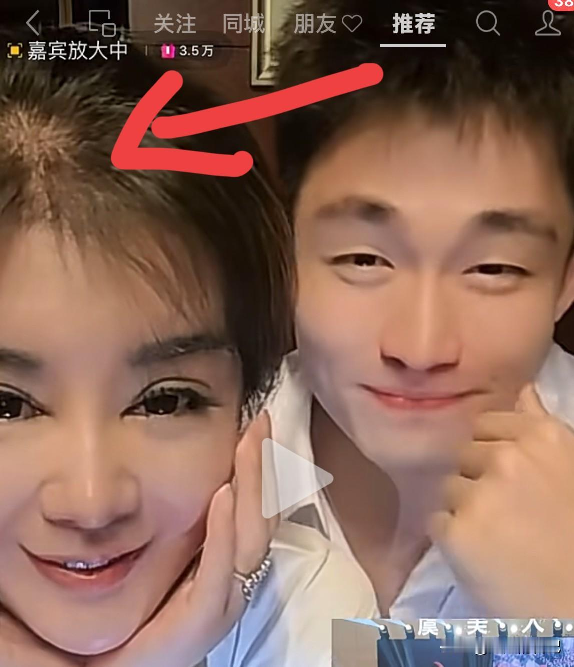 于文红头顶的头发怎么没了，不是做了植发么？怎么还那么少的头发呀。
日前看到她的直