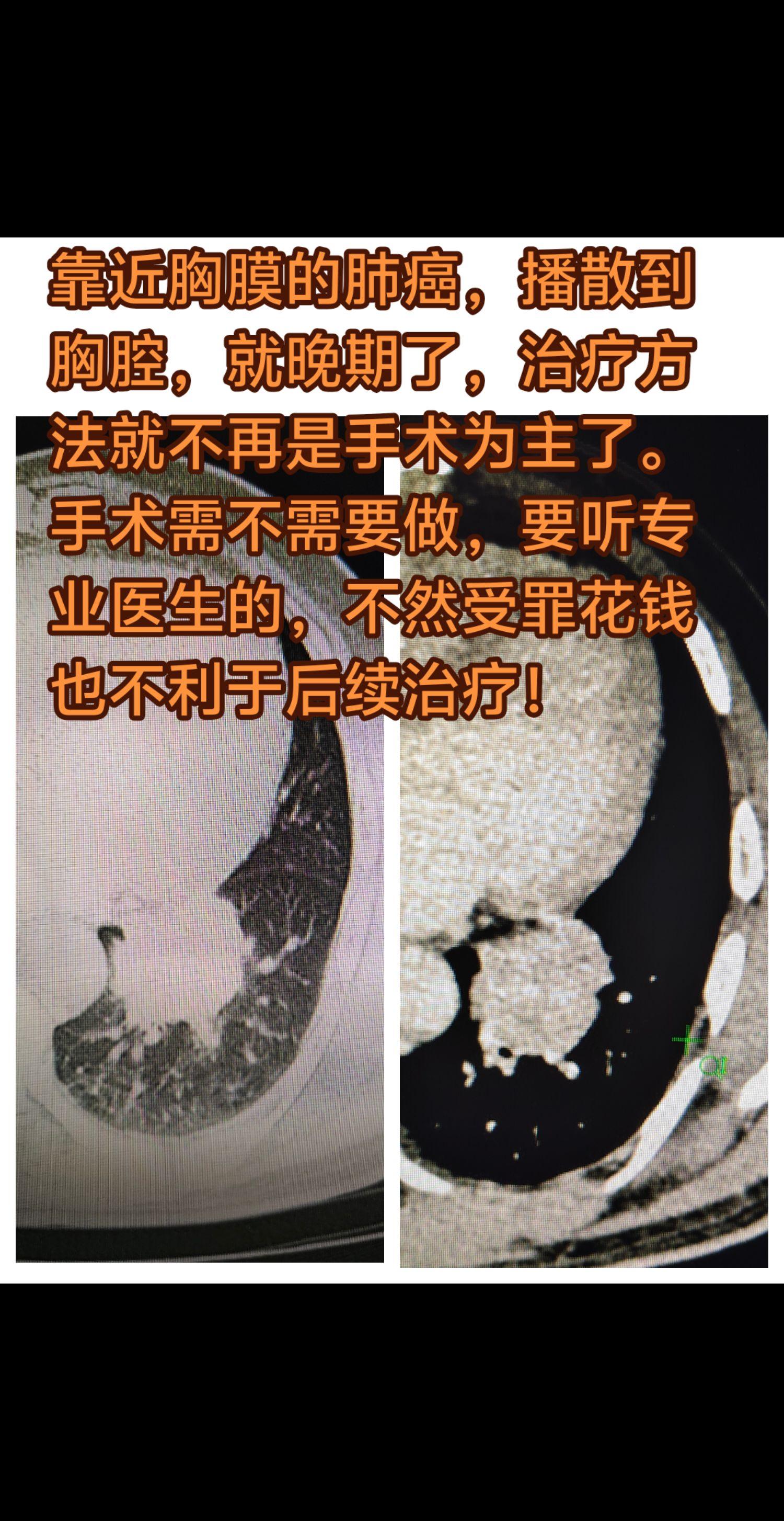 肺癌手术的必要性。靠近胸膜的肺癌，播散到胸腔，就晚期了，治疗方法就不再...