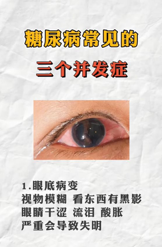 糖尿病人视物模糊、腿麻起泡沫尿，当心三大并发症找上门