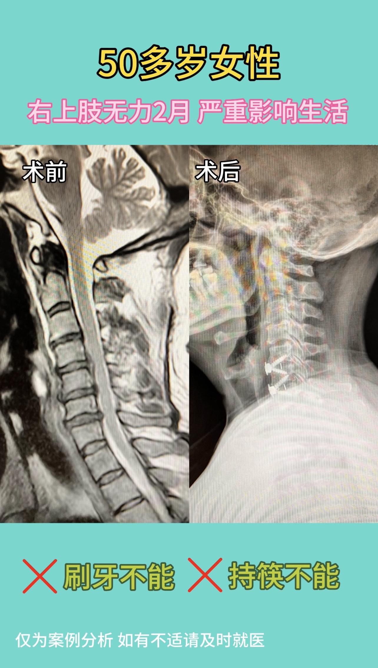 50多岁女性，右上肢无力2月，刷牙不能，持筷不能。严重影响生活。术后1...