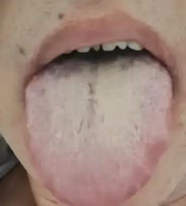 3 味药，专治 “四邪夹杂” 舌！10 天理顺血瘀、痰湿、脾虚、肺热！

有位患