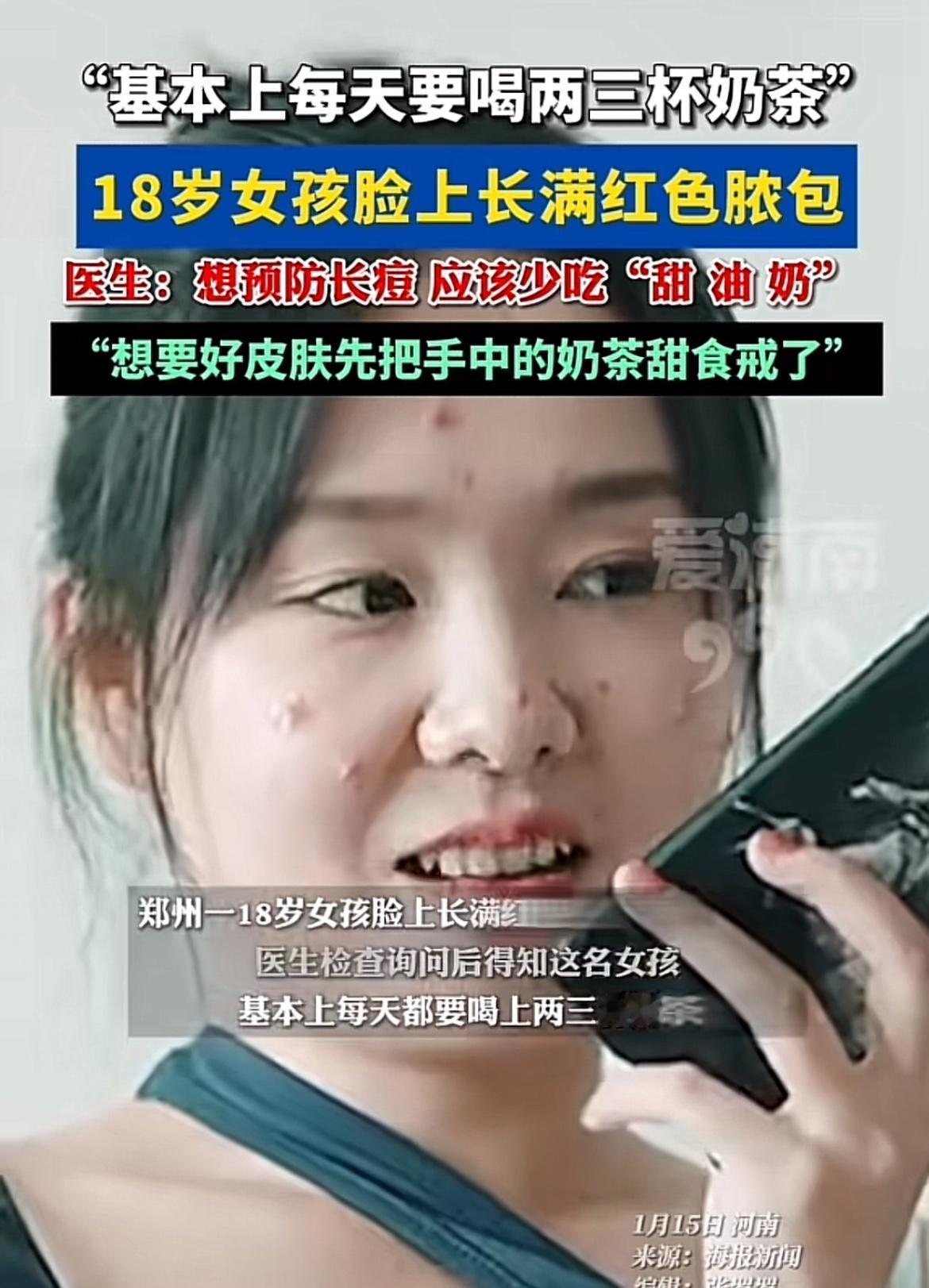 奶茶好喝，可痘痘找上门就糟心了。医生建议少吃“甜油奶”，奶茶就在其中。很多人长痘