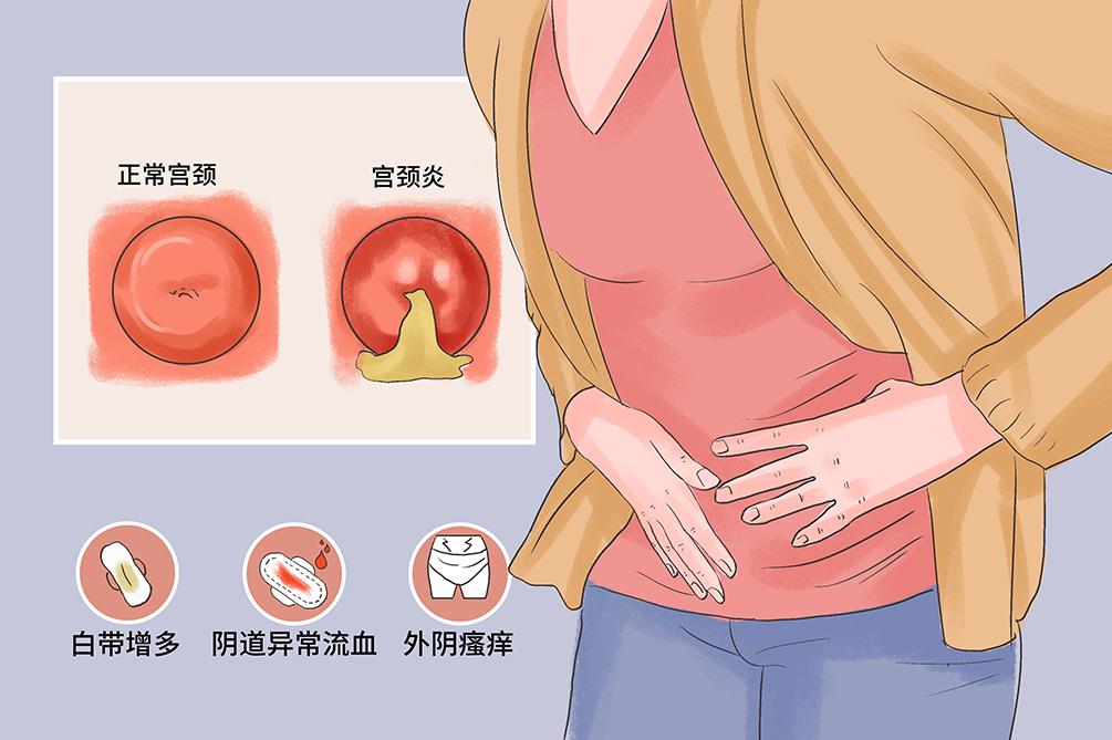 #健康真探社#【得了宫颈炎为何没感觉？】宫颈炎主要分为急性和慢性两种。急性宫颈炎