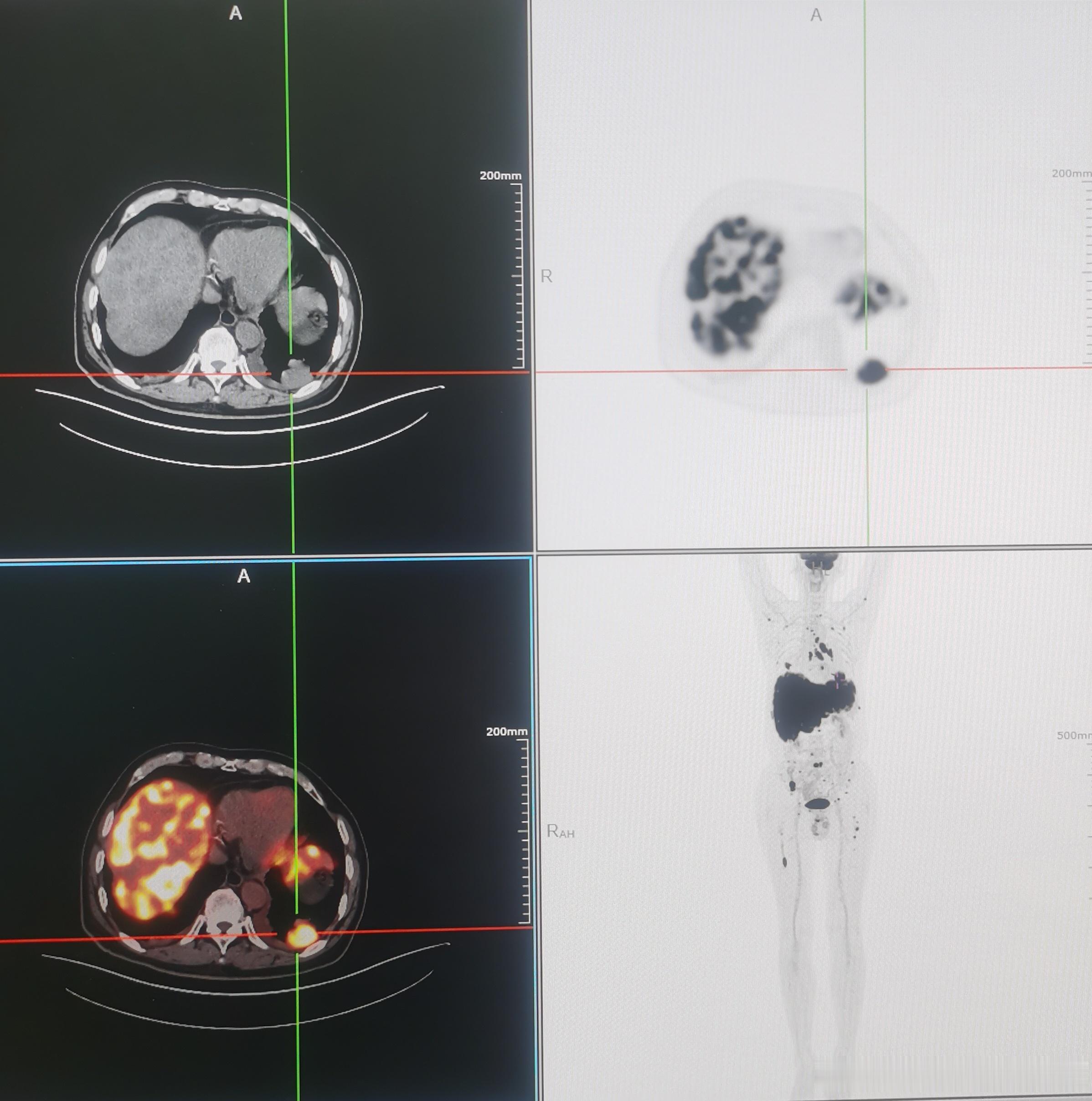 一例今天刚做的PET/CT患者:左肺下叶后基底段的3公分多的小细胞肺癌，没想到淋