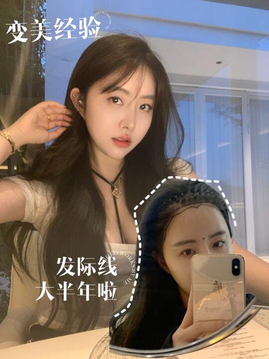 植发后八个月，我的头发终于“重生”了