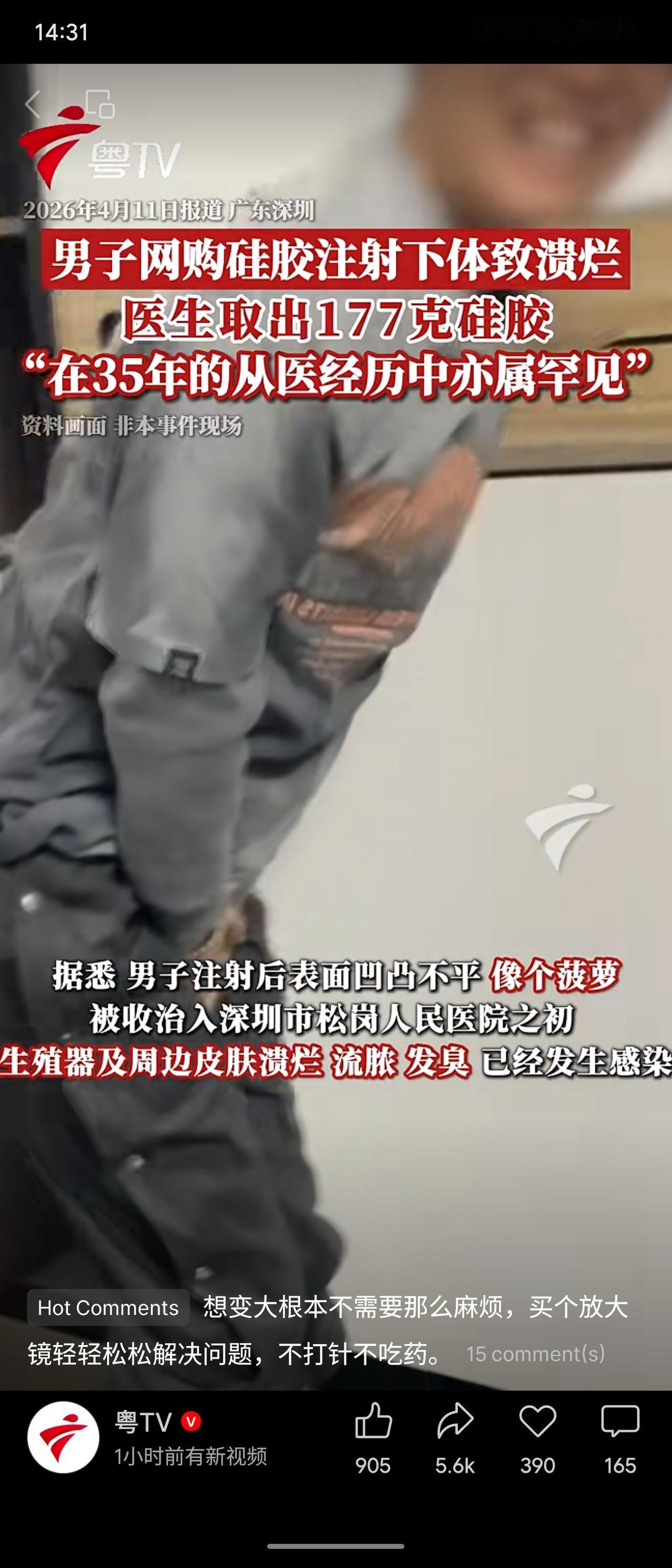 深圳一男子为求增大，网购硅胶自行注射下体，导致生殖器及周边皮肤溃烂、流脓、发臭，