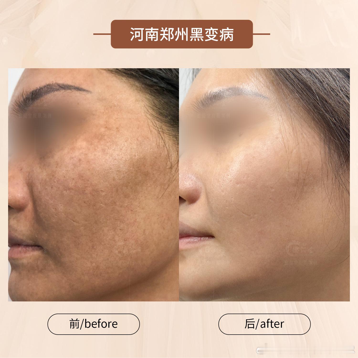 瑞尔氏黑变病[超话]  何女士面部发黑发黄，还有明显的黑斑，看了很多地方后，选择