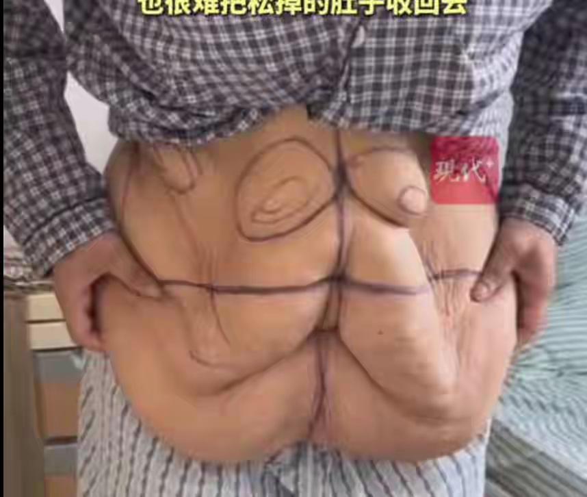 尴尬！江苏44岁杨女士重达300斤，为了身体健康做了切胃手术，硬生生减掉150斤