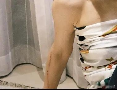 张子枫拍《我们生活在南京》手臂上留了一条十几厘米的疤张子枫手臂上好大一个疤