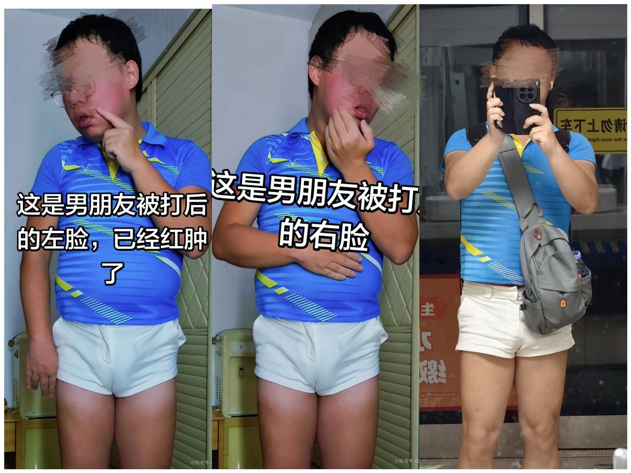 只因穿女友短裤散步，年轻男子当街被人左右开弓，双颊红肿。
有网友发帖，称近日晚上