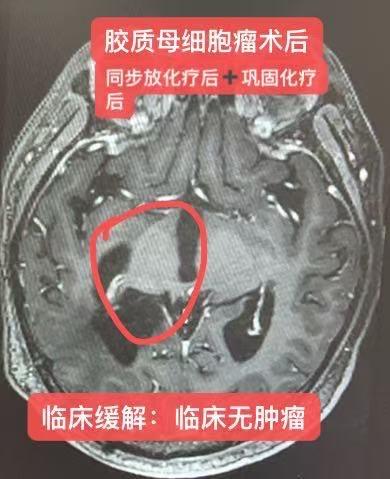 脑干胶质母细胞瘤术后残留。脑干胶质母细胞瘤术后残留 患者男，36岁，头...