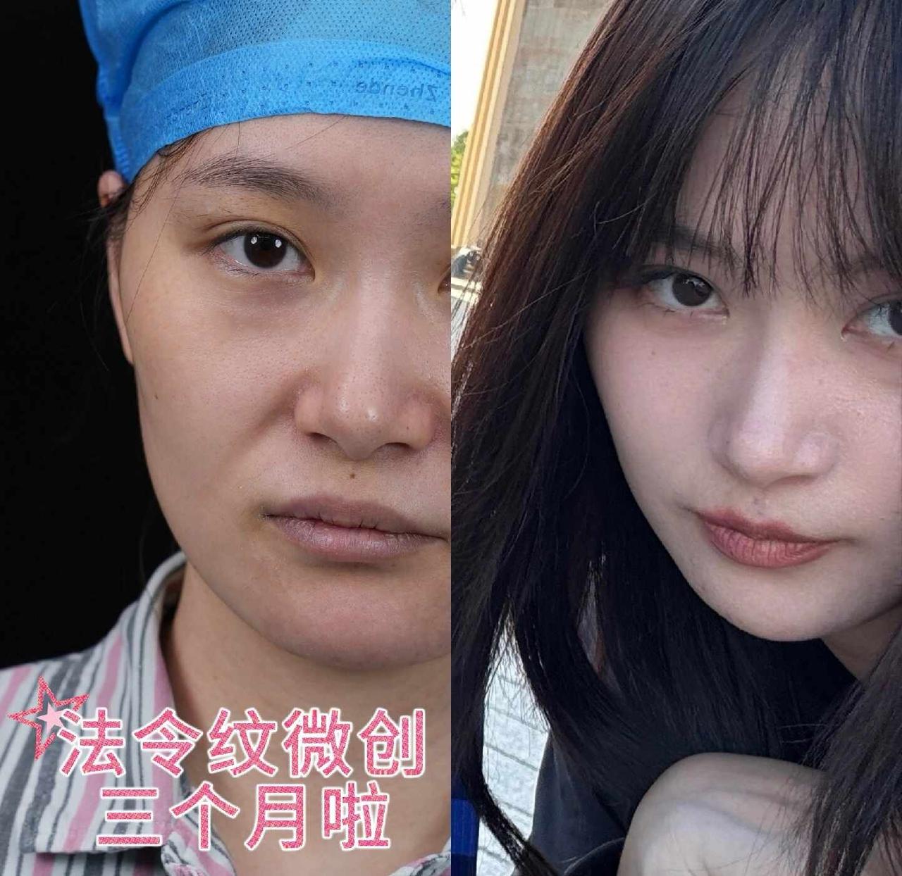 说说改善法令纹的纯感受吧
刨除一切外界因素，目前三个月，看着比之前的法令纹改变了
