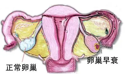 卵巢早衰分三级，你在哪一层？ 大家好，今天我们聊聊卵巢早衰。这种情况其...