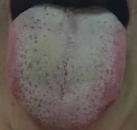 湿热重不重，到底该怎么判断呢？中医教你，一看舌苔，二看饭量！

一湿在，百病生！