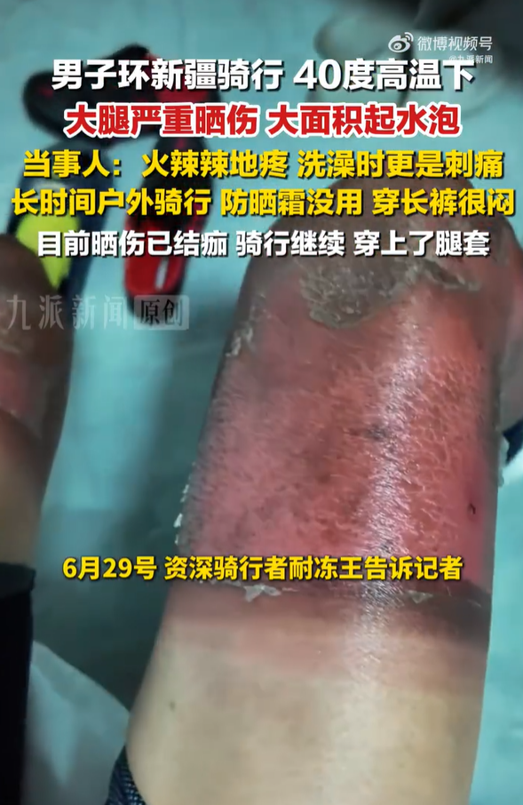 男子环新疆骑行，40度高温下大腿严重晒伤，当事人：晒伤部分已结痂，将继续骑行