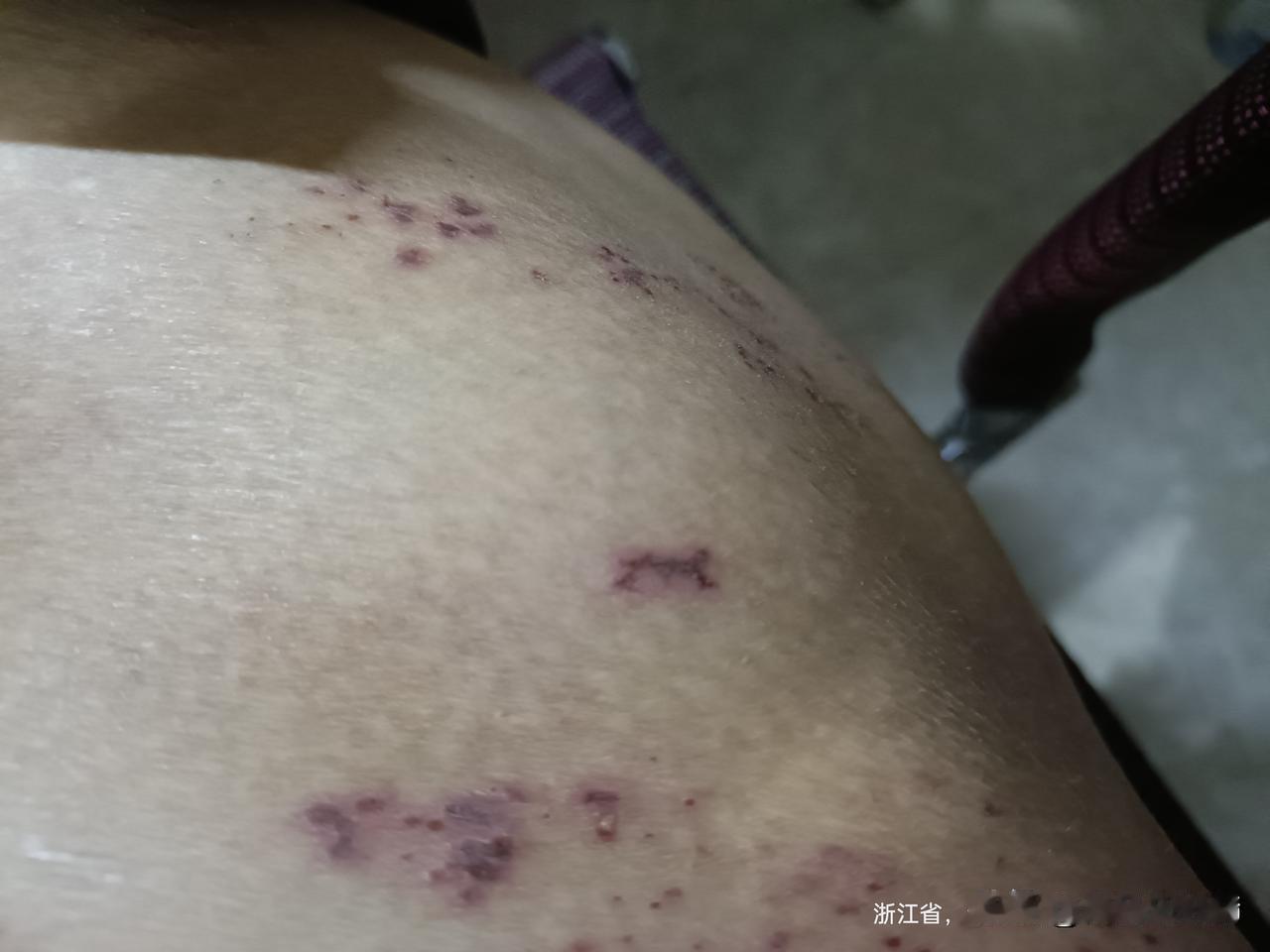 挂了四天针

本来说输液4天，今天去挂完了，说明天再挂一天，药再擦3-4天，唉。