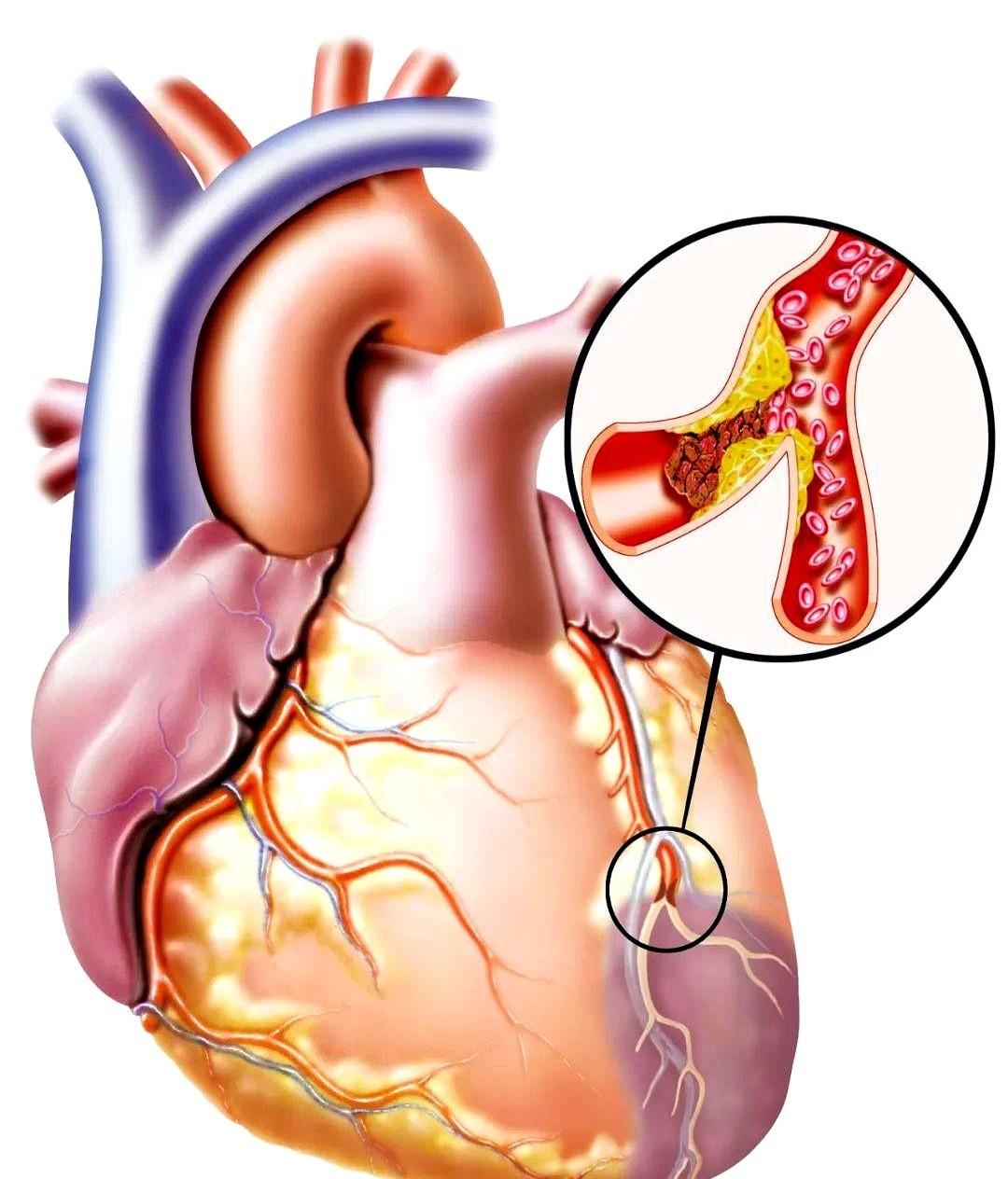 都说心梗要命，但没几个人知道，它来之前，身体会用一种最“狡猾”的方式给你打招呼。