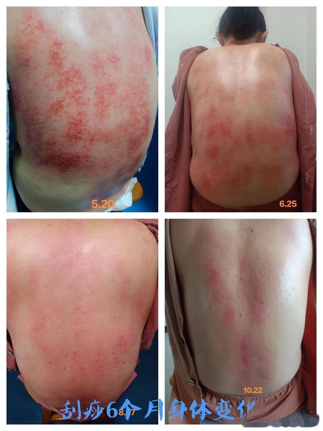 健康营西安一期同学的刮痧实践分享在实践中不断领悟中医的至深之理#厚朴健康营[超话