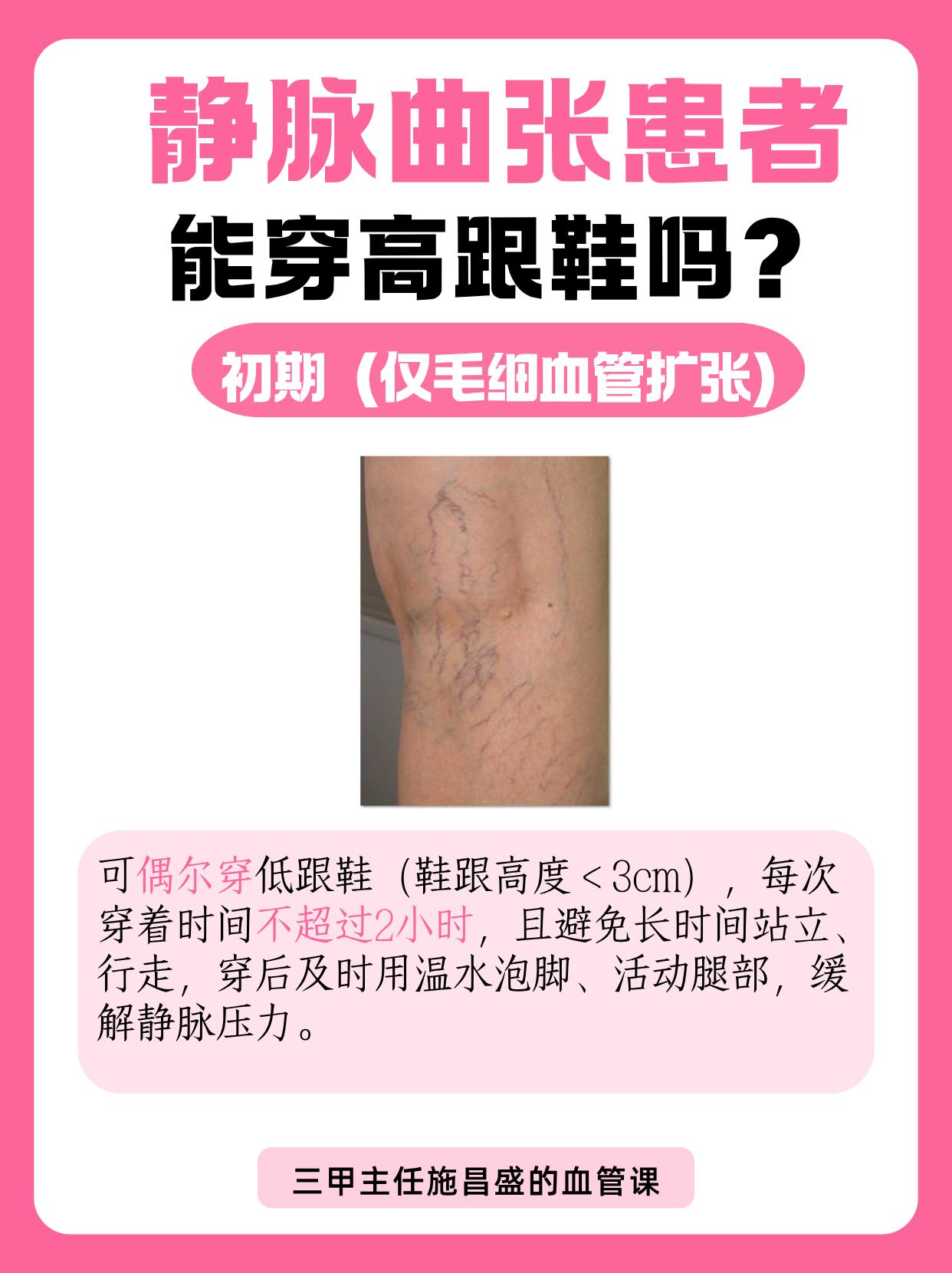 静脉曲张患者能穿高跟鞋吗？。很多女性患者关心“能否穿高跟鞋”，需根据病情阶段判断
