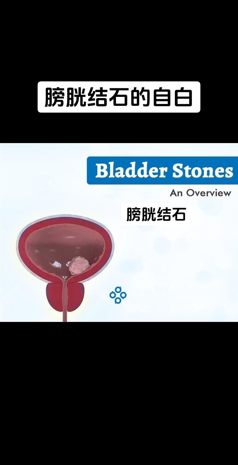膀胱结石。