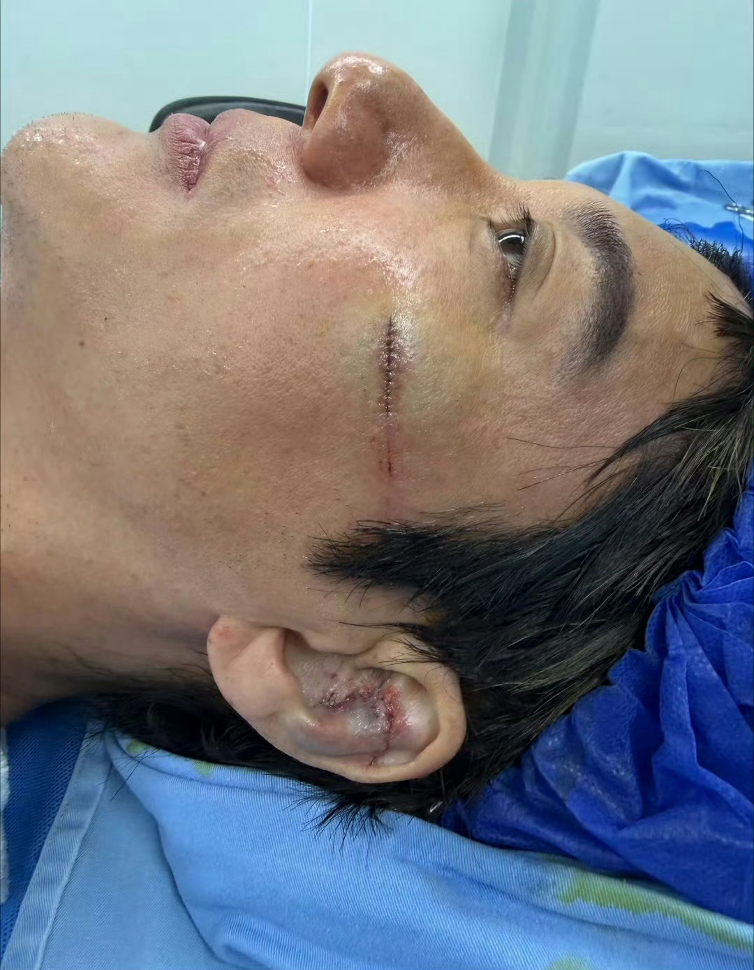 王力宏缝了39针 王力宏受伤很严重，这样的事故不容易，安全没有做好，安全第一位。