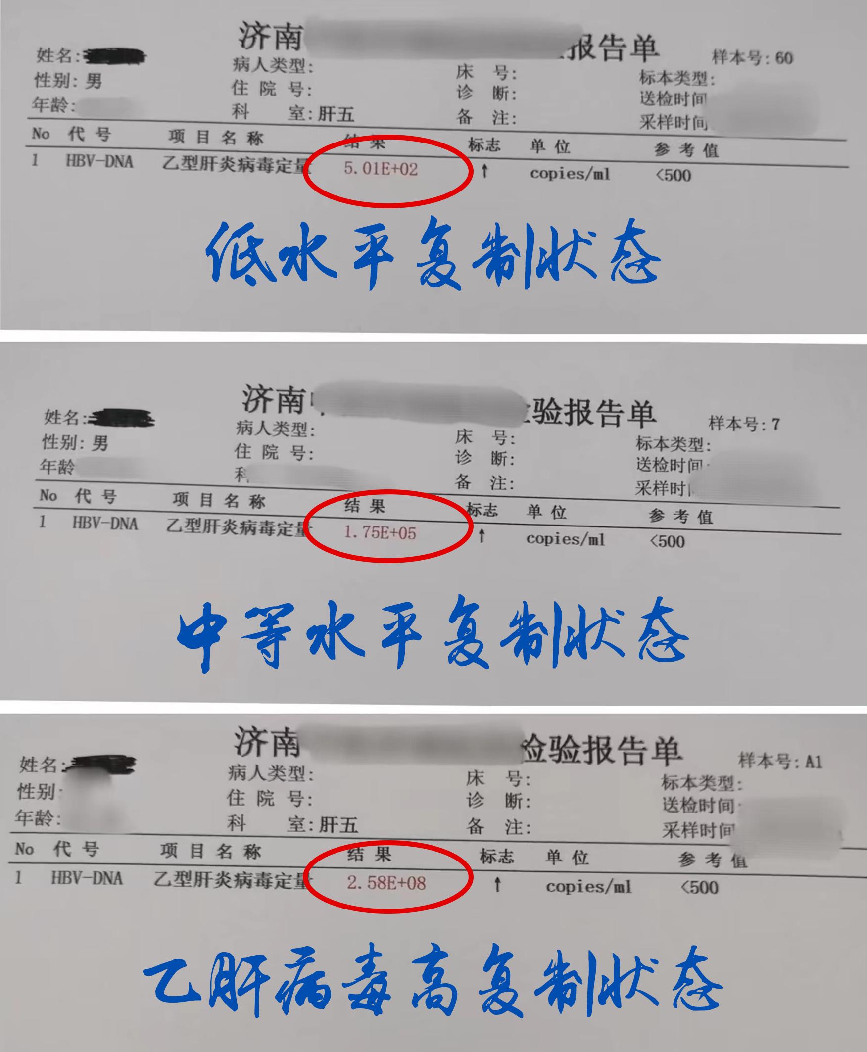 乙肝病毒复制水平怎么看？高水平、中等水平、低水平复制，看看你的病毒量处...