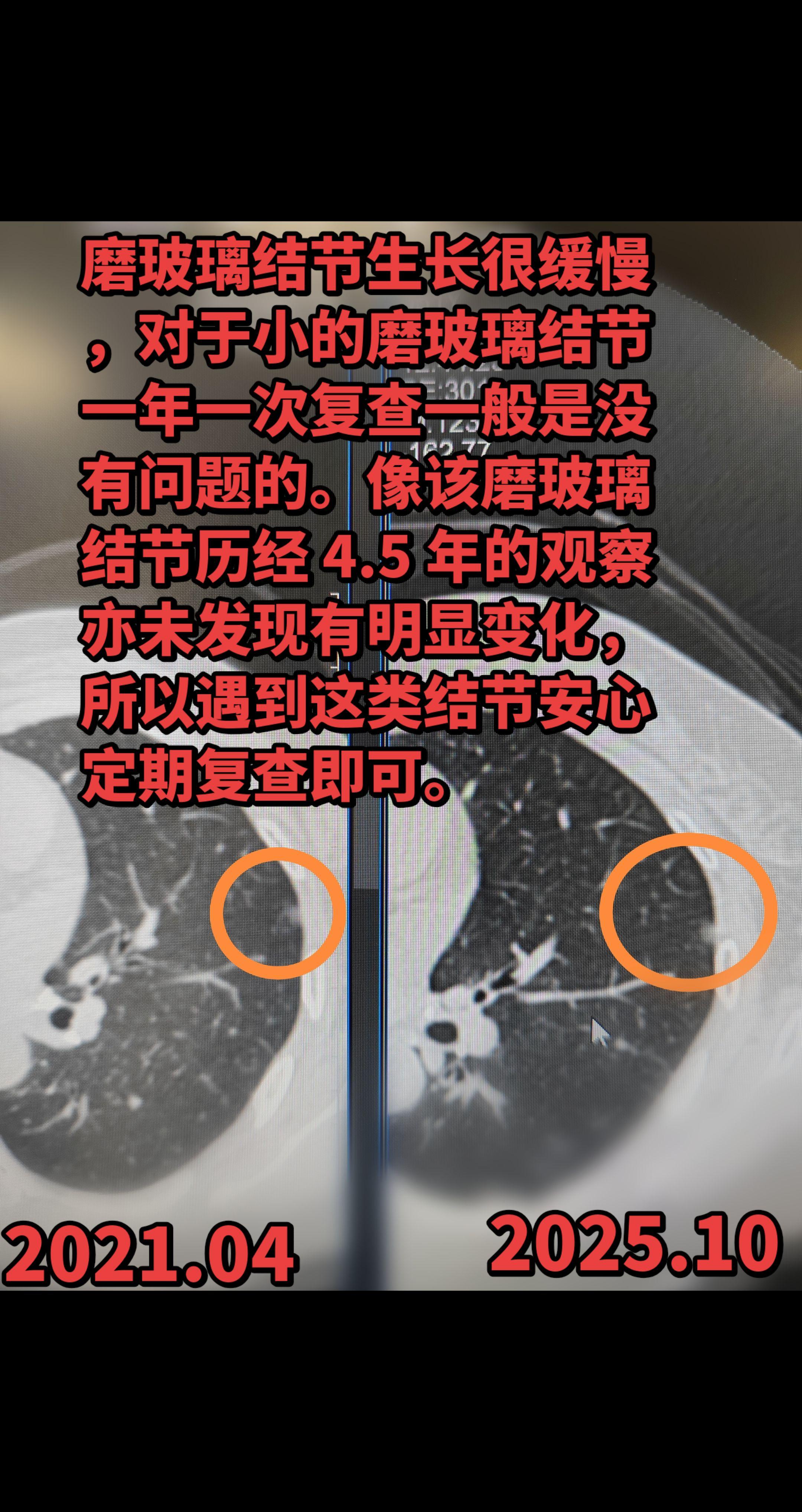 小的纯磨玻璃结节年度复查即可。磨玻璃结节生长很缓慢，对于小的磨玻璃结节...