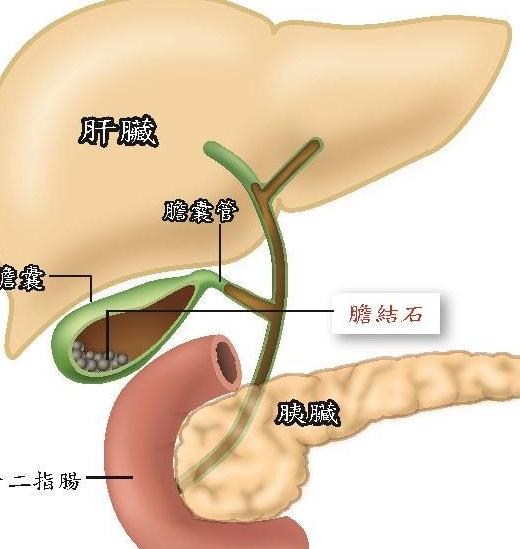 为什么肥胖和快速减肥，都可能增加胆结石的风险？
很多人以为胆结石是“吃出来的”，