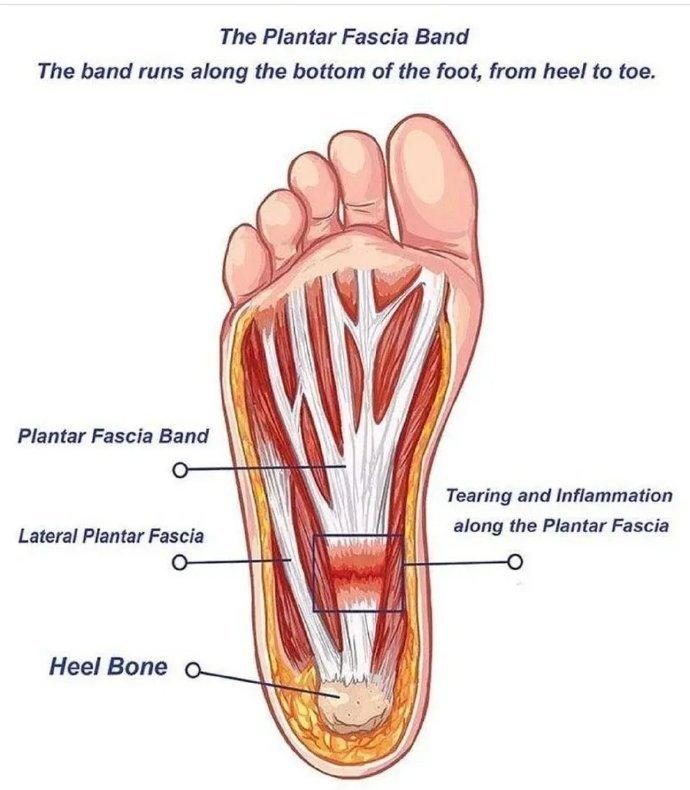 #国医的精诚力量# 为什么脚掌痛脚底从脚跟到脚趾的筋膜。（如图是足底筋膜束）劳动