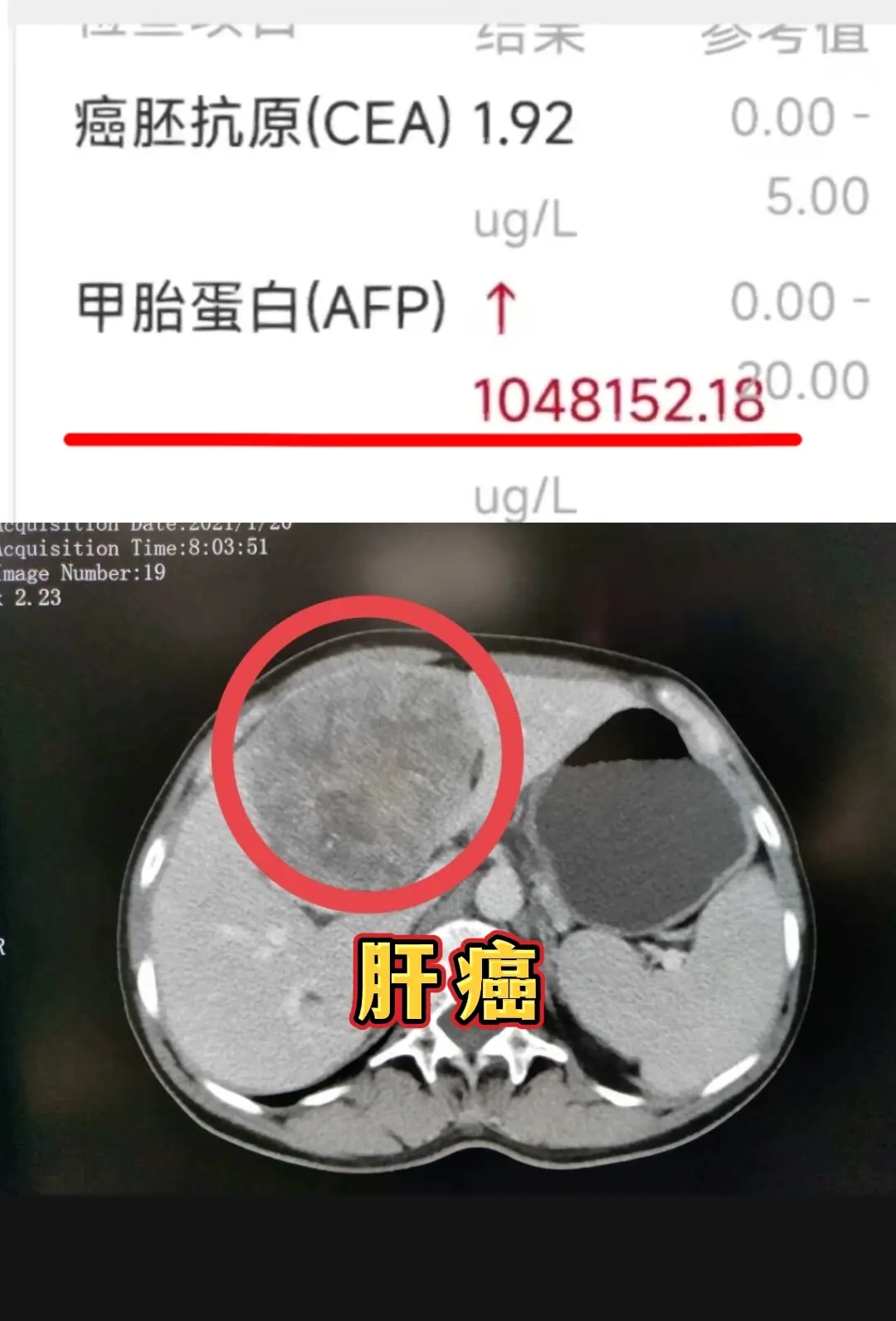 甲胎蛋白104万！简直瘤上长了肝 这位山东潍坊的老兄甲胎蛋白104万...