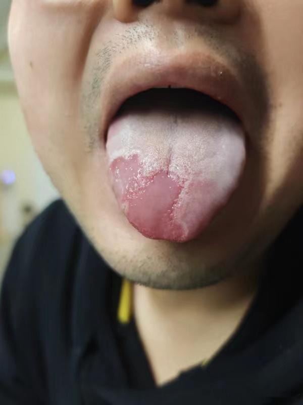 来来来，今天给大家看一个断食减肥的真实案例，新鲜出炉的舌相主人翁也算是俺家老客户
