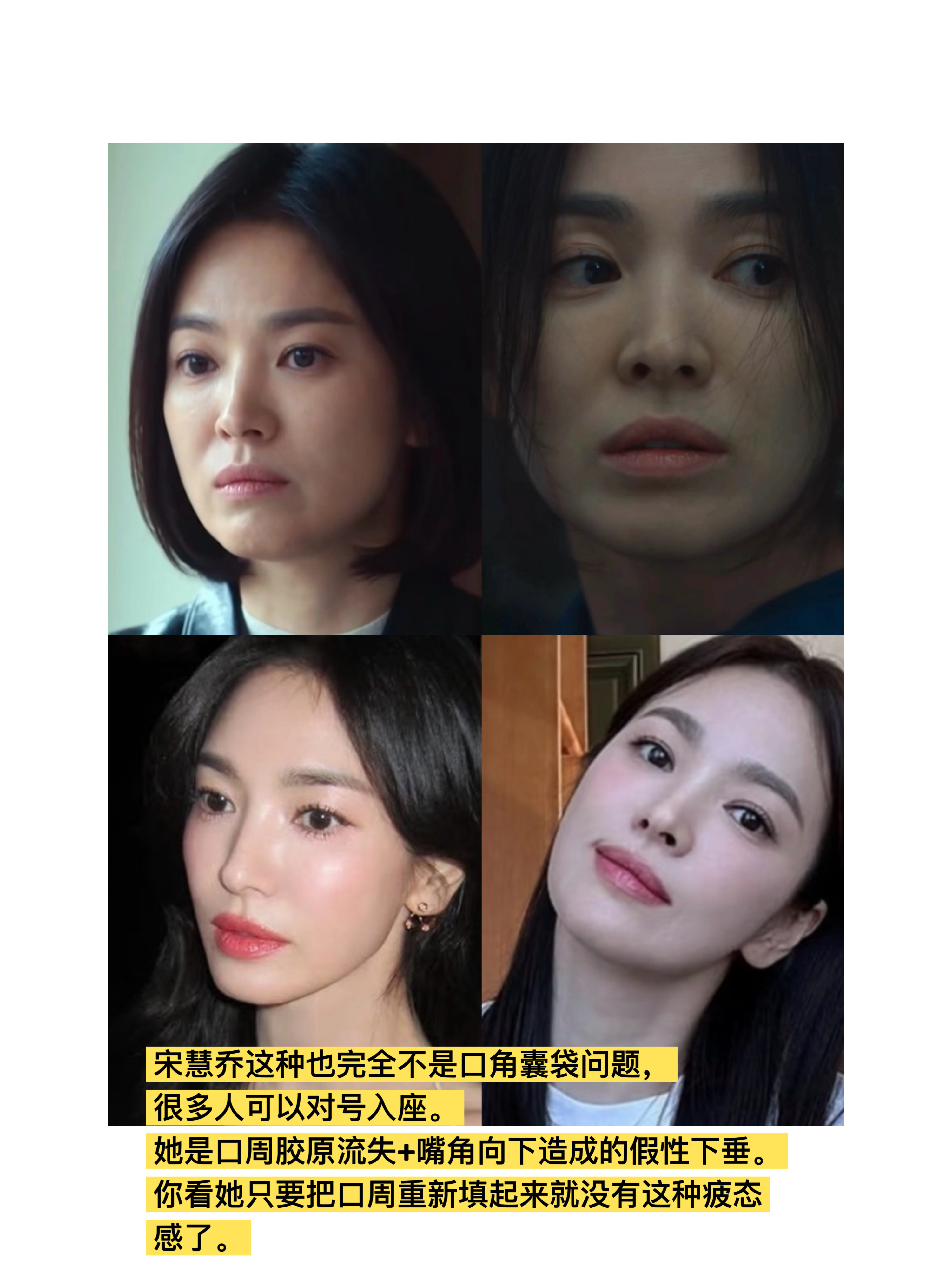 nl医美笔记 【口角囊袋大全篇】大部分口角囊袋产生的原因是什么，是：1.（深层）