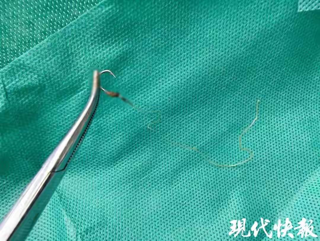 江苏镇江，59岁女子突然感到屁股眼钻心疼，她下意识摸了一下，摸到一根线，一拉疼得
