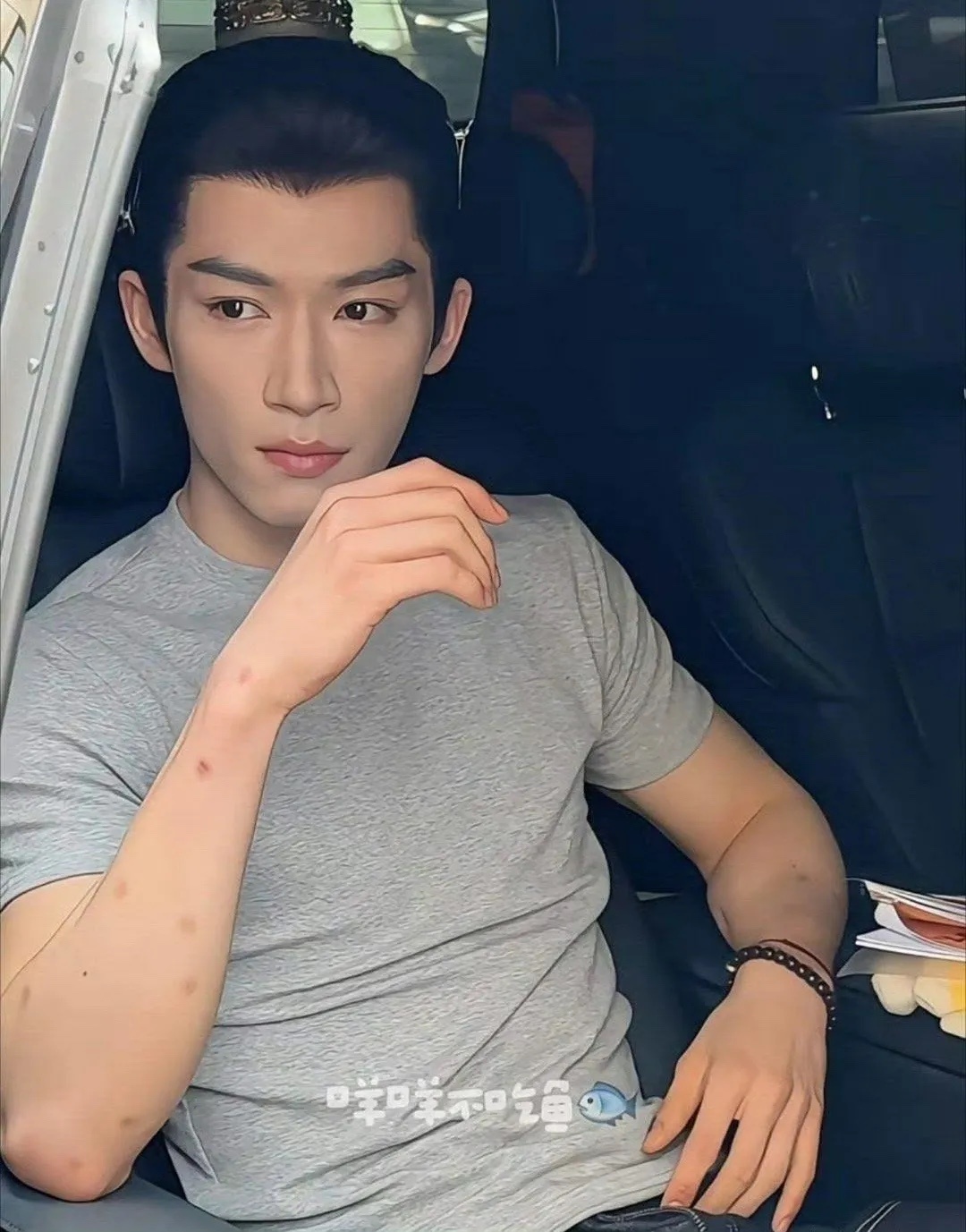 王星越这胳膊上密密麻麻的圆点是啥？蚊子咬的吗？ ​​​