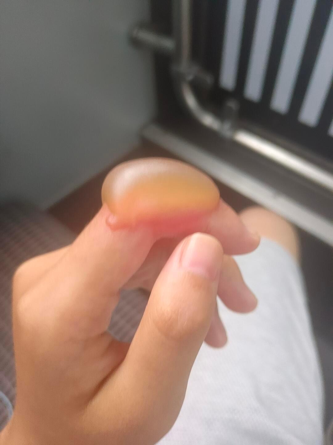 兄弟们 水泡这种程度的烫伤怎么处理日常