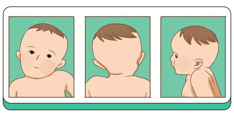 新生儿有斜颈是一个非常常见的现象。因为胎儿在子宫内会保持蜷曲状态，随着生长，颈部