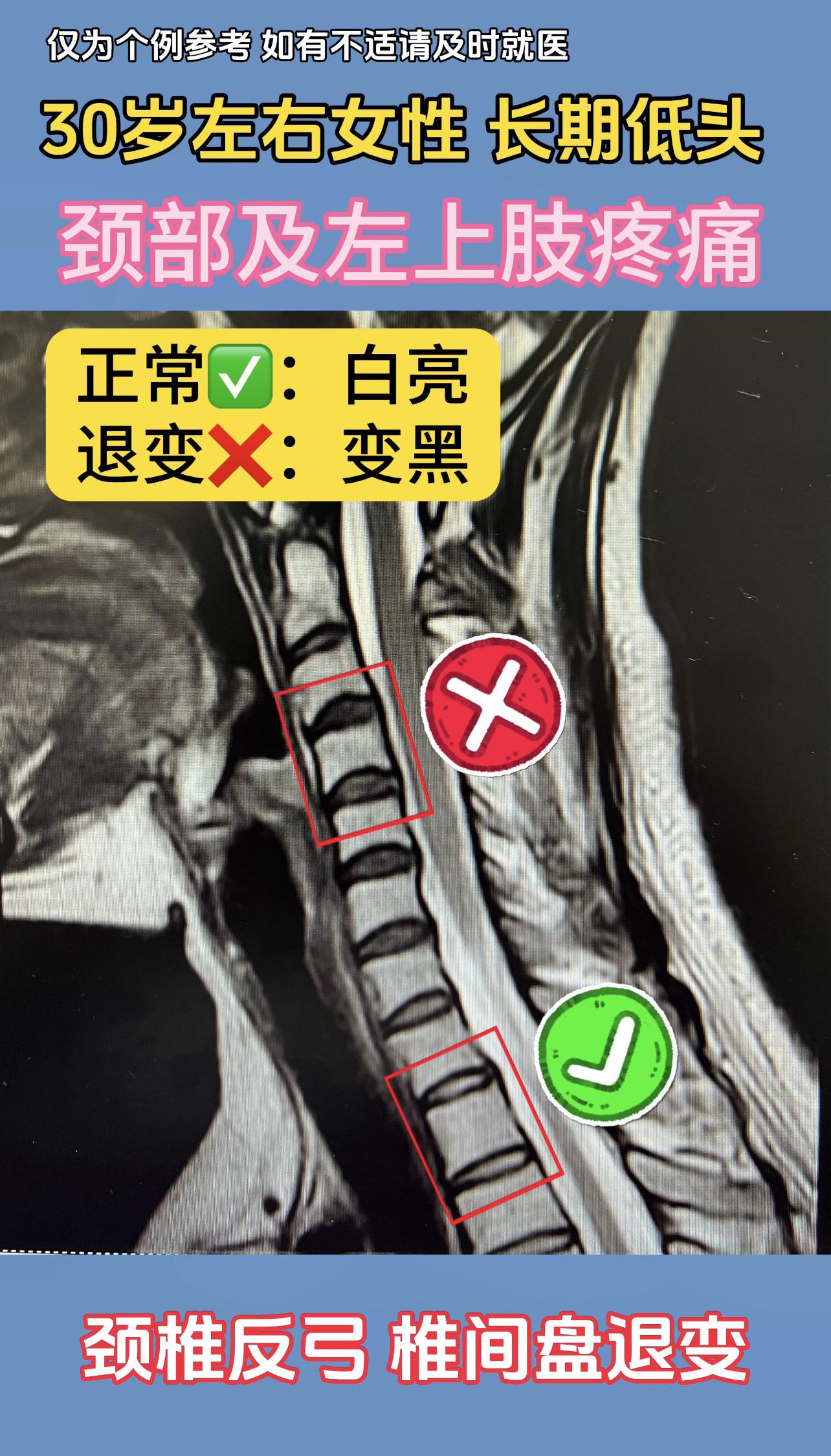 30岁左右女性，长期低头，颈部及左上肢疼痛。颈椎反弓，椎间盘退变。正常椎间盘信号发白发亮。退变椎间盘变黑