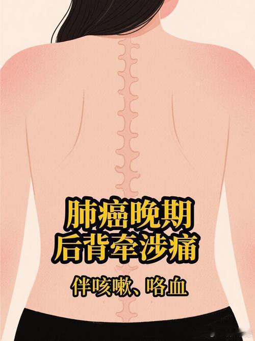 00后女生咳嗽腰疼一查已是肺癌晚期四川00后汪女士，26岁，不抽烟不熬夜，生活比