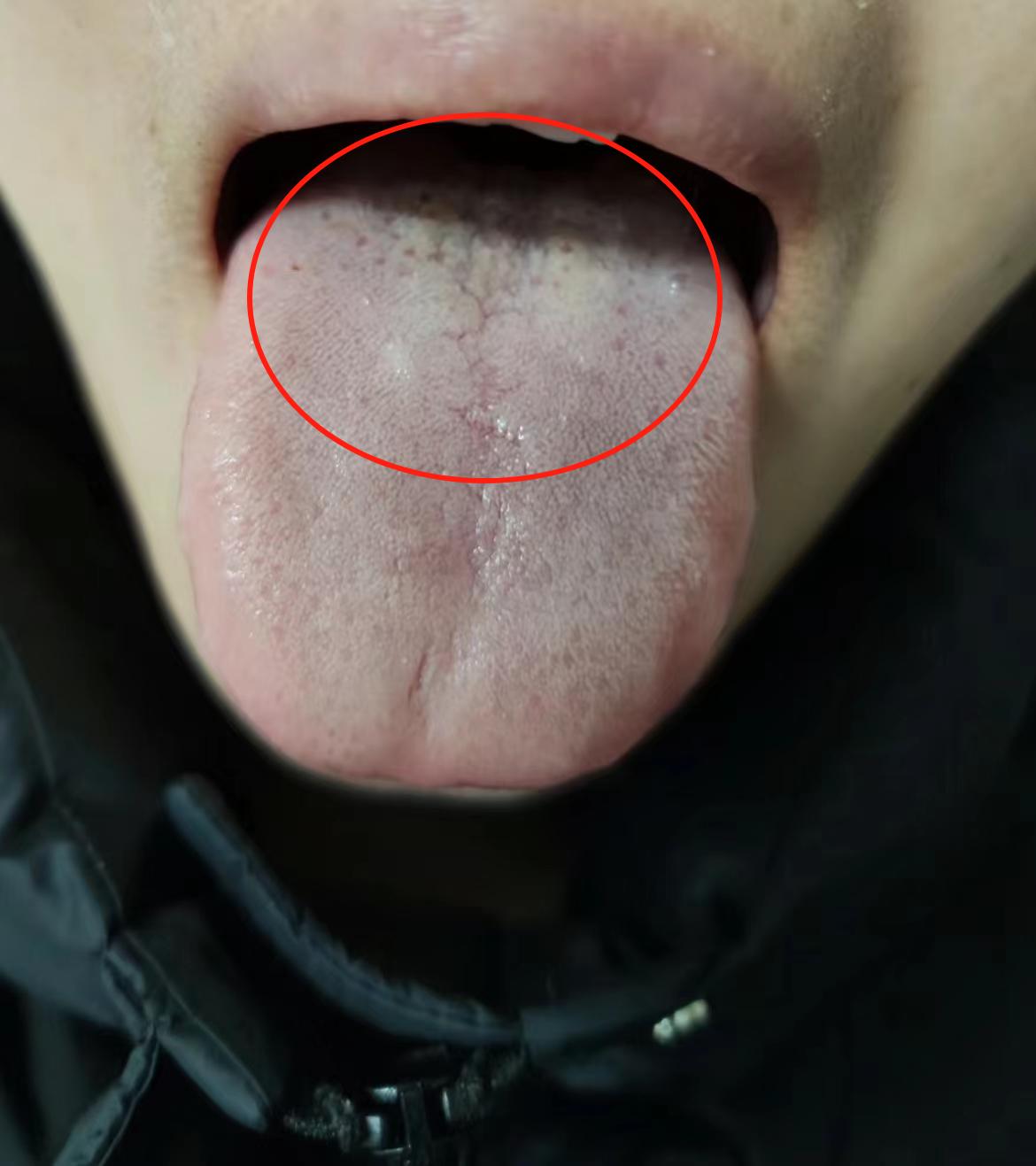 你这舌头补肾前，先温阳散寒，健脾祛湿！[中国赞]
患者自述：以前总喜欢吃凉的，现