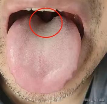 舌头有凹陷要注意，四个凹陷表示四个脏器虚

1. 脾气虚
一般出现在舌头中间，舌