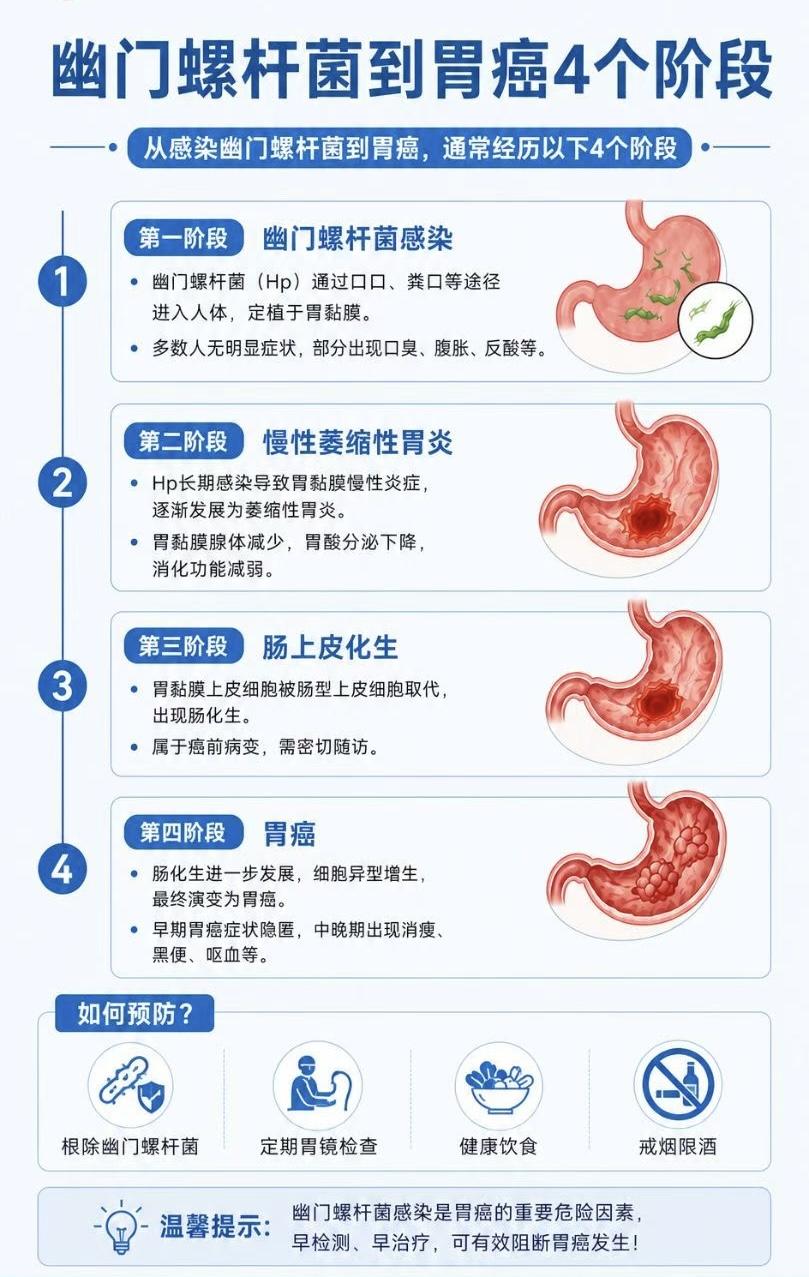幽门螺旋杆菌→胃癌的4个阶段


警惕幽门螺杆菌感染，重视反酸胃胀等小信号
及时