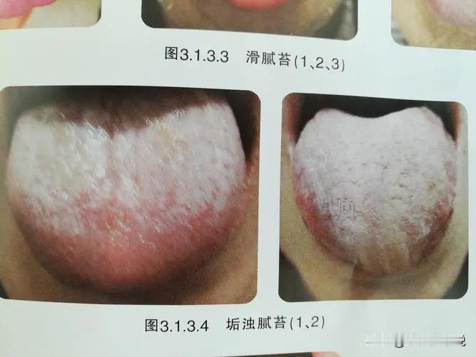 苔腻都要去运化，不要乱补。
像腐腻苔是比较的常见的病理舌苔，辨证来看是脾气亏虚，