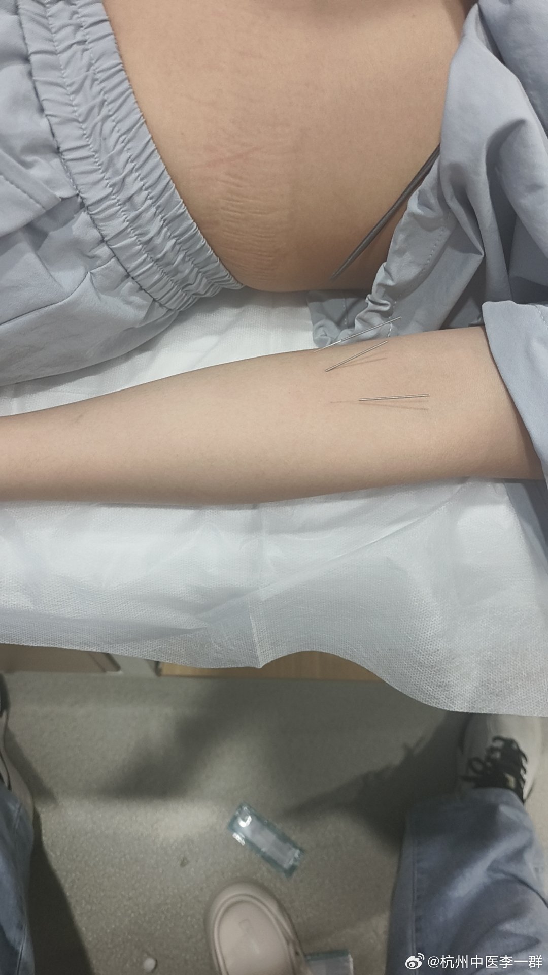 扎针中医养生 杭州