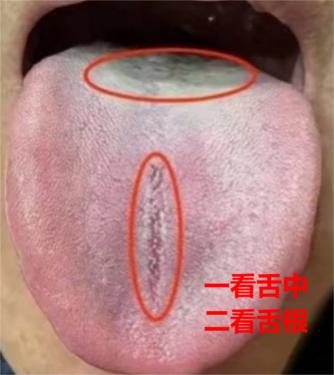 舌中裂纹、舌根厚腻苔多提示脾肾两虚，舌边鼓胀可能伴随肝郁，这类情况需按 “先通后