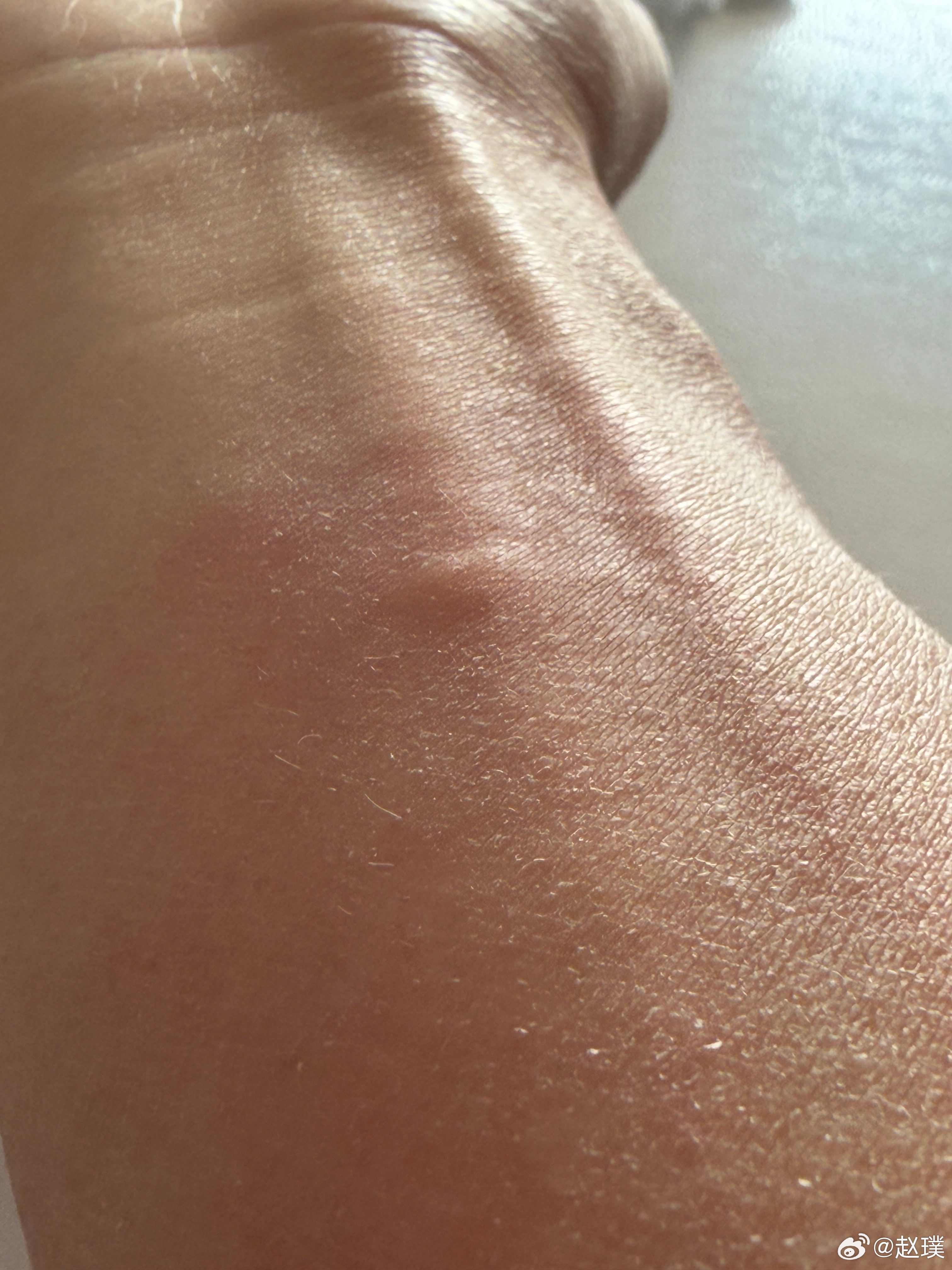 2026的第一个蚊子包🦟